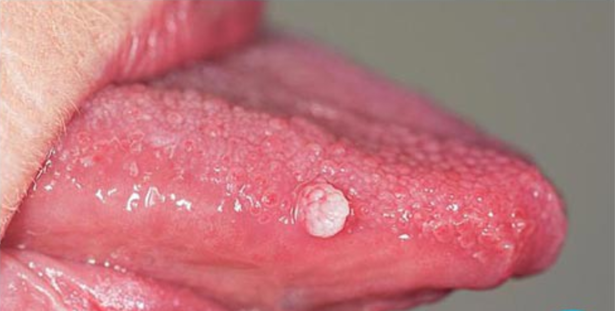 Sùi mào gà ở lưỡi có đau không còn tùy thuộc vào giai đoạn của bệnh