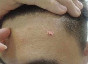 Sùi mào gà ở trán gây mất thẩm  mỹ cho khuôn mặt