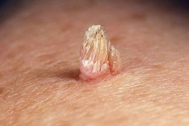 Sùi mào gà, tên gọi khác là mụn cóc sinh dục, là một trong các bệnh lây truyền qua đường tình dục do virus HPV