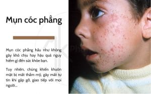 mụn cóc phẳng