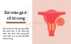 Sùi mào gà cổ tử cung