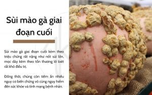 Sùi mào gà giai đoạn cuối
