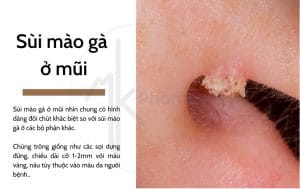 Sùi mào gà ở mũi